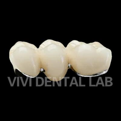 China Semi Precious Alloy Crowns PFM Restorations VIVI Dental Laboraotry for sale