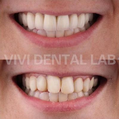 중국 NI Be Free Dental Crowns In Mouth 프로페셔널 FDA 인증 판매용