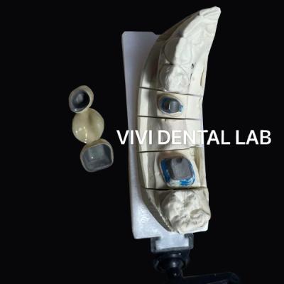 China VIVI Post Núcleo y Corona Ni Ser Restauración dental gratuita en venta