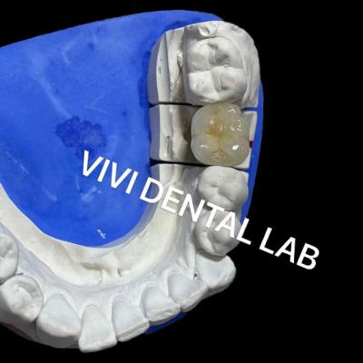 China Ivoclar Scheftner Coronas de porcelana metálicas Coronas de cerámica metálicas Ni estar libre en venta