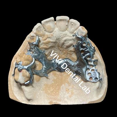 China Dentes parciales de titanio ligeros Dentes digitales de Exocad 3shape en venta