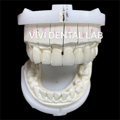 China Alta Estética Coroas de Laboratório Dental de Zirconia Ponte Com Porcelana em Camadas à venda