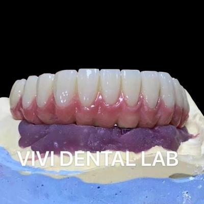 Cina Implantazione di ponte a supporto dentale a veneer composito Ivoclar personalizzato in vendita