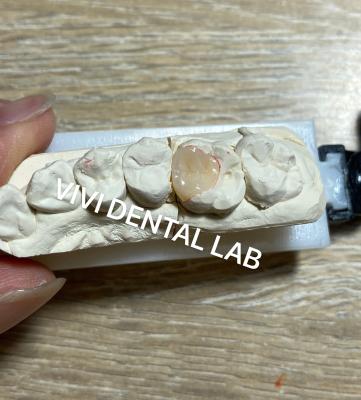 Cina VIVI Composite Dental Inlay Onlay Alta estetica certificata ISO in vendita