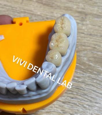 Cina Corone dentali digitali ad alta precisione in vendita