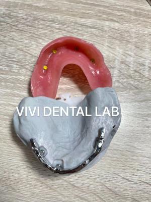 Cina Ivoclar Digital Dental Implant Bar Denture Con Appendici in vendita