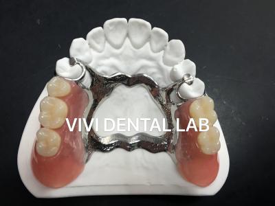 China Alloy Metal Partial Denture Framework 3 Shape Exocad Laser Printing for sale