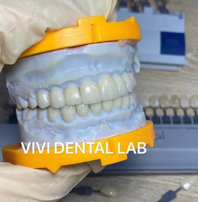 Cina L'alto laminato estetico di Emax dei denti impiallaccia il laboratorio dentario della Cina della traslucidità Incisal in vendita