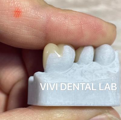 Cina Professional Emax Dental Inlay Onlay Alta precisione di elaborazione digitale in vendita