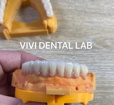 Cina Impianto dentale a mascella piena Ponte di zirconia Corona traslucidità Estetica in vendita