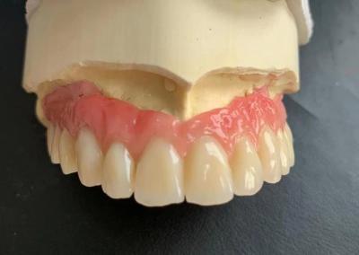 Cina Denti protesi supportate da impianti telescopici di corona Ivoclar Scheftner su abutmenti in titanio in vendita