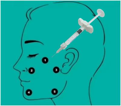 中国 非32mg H-HA L-HAの十字によってつながれるHyaluronic酸の注入口のHyaluronic酸のゲル 販売のため