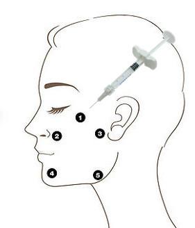 Китай Заполнитель Profhilo H+L 32mg OEM не соединенный крестом Hyaluronic кисловочный 5 пунктов впрыски продается