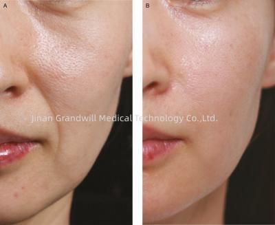 China PCL Cross Linked Hyaluronic Acid Dermal Filler Polycaprolactone zu verkaufen