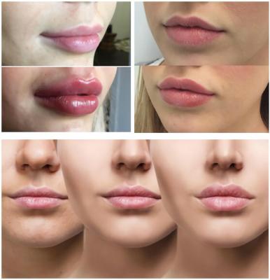 China Vlotte Lijnen/Mollige Lippen met Hyaluronic Zure Injecteerbare Vuller 1ml 2ml 5ml Te koop