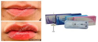 China Cross Linked Sodium Hyaluronic Acid Injection Dermal Filler For Lip Fullness Facial Wrinkles Te koop