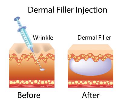 China Hyaluronsäure-Füllstoffhersteller Injektierbares modifiziertes Natriumhyaluronat-Gel für Gesicht und Körper zu verkaufen