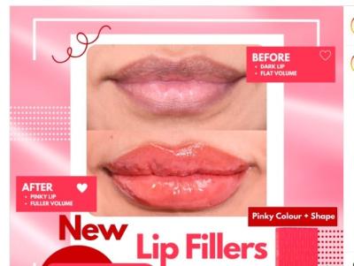 Cina Enhance Your Lips With RED Patented Lip Filler Safe And Effective Lip Augmentation in vendita