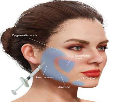 China Hyaluronic Acid HA Calcium Hydroxyapatite Filler Get Natural Looking Face With 1ML Syringe for sale