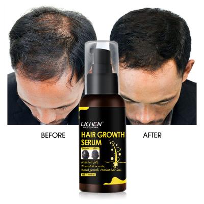 China Hot Selling Private Label Hair Loss Prevention Hair Care Serum Hair Growth Serum Natural Herbal Treatment For Bald Hair for sale