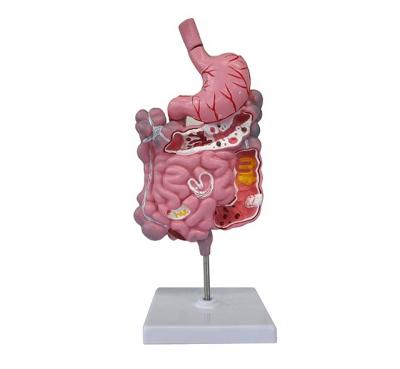 China Lasting Human Sick Abnormal Digestive System Anatomy Structural Model for sale