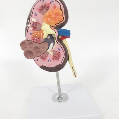 China New medical nursing teaching size YA/U023 human kidney cyst model for medical science for sale