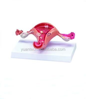 China YA/P016 medical science and education sick uterus model for sale