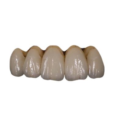 China Fácil mantenga la estabilidad del color dental de la corona de la porcelana ortodóntica de PFM en venta