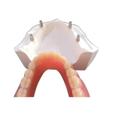 China Comfortable CAD CAM Dental Implant Overdenture Easy Maintain for sale