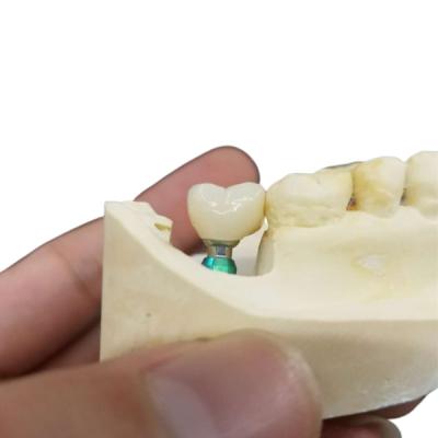 Cina Colore ultra duro l'OEM che di stabilità la corona dell'impianto dentario facile mantiene in vendita