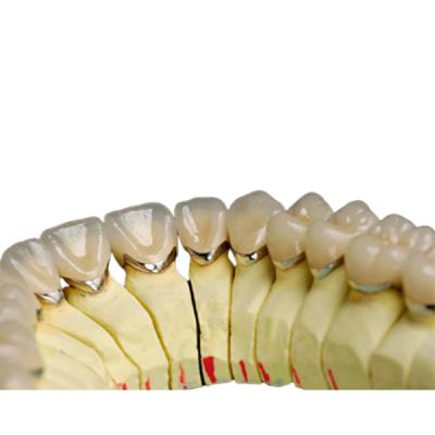 China Dental Laboratory Titanium alloy Porcelain Dental Crown Natural Metal Porcelain Tooth for sale