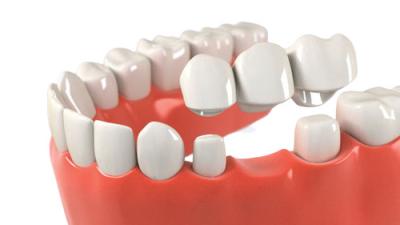 Cina OEM Dental Crown Bridge Good Biocompatibility Smooth Surface Make Smile Sweeter in vendita