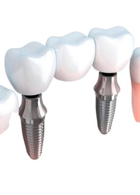 Cina Ponti realistici di aspetto e colore naturale stabilità dentaria delle corone di forte in vendita