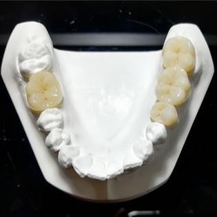 China Standvastige Kwaliteit de Mark Of Our Ceramic Dental-Kronen Te koop