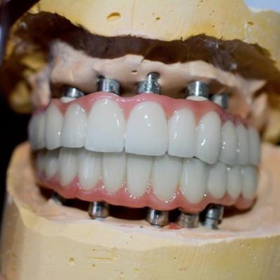 China El viaje a una sonrisa sana nuestro proceso de la corona del implante dental en venta