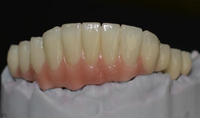 China Abrazando adelantos tecnológicos el futuro de las coronas del implante dental en venta