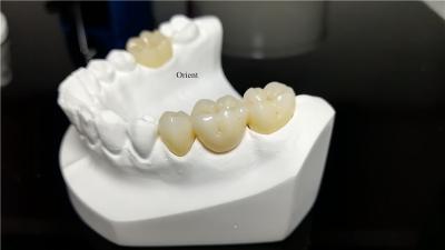 China Keramische tandheelkundige kroon, Zirconia tandheelkundige kroon Te koop