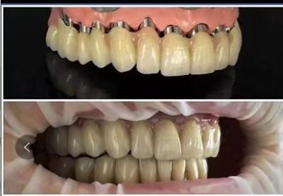 Κίνα Dental implants Telescope PFM porcelain bridge προς πώληση