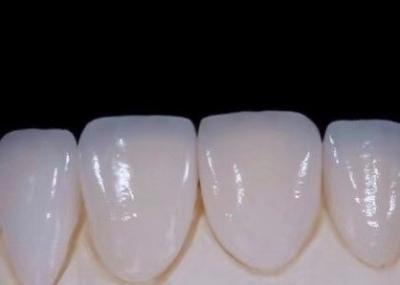 China EMAX Durabilidad Carillas dentarias compuestas CAD/CAM Muy detalladas Exactas en venta