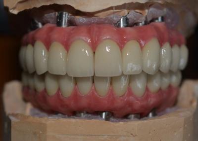 China Satisfacción paciente de la prioridad nuestro compromiso con las coronas del implante dental de la calidad en venta