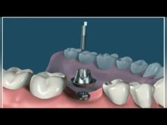 Easy-To-Clean  Dental Implants Comfortable And Convenient PFM Dental Implants