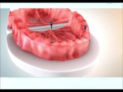 Removable Denture Fixation Methods