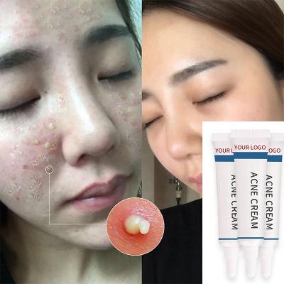 China Natural Organic Herbal Private Label 30g Moisturizer Custom Moisturizer Pimples Mark Anti Removal Acne Face Cream for sale