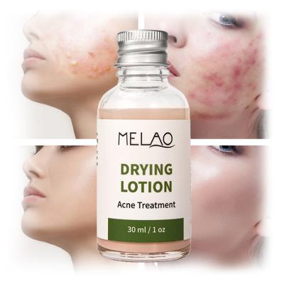 China Effective MELAO Skin Revitalizer Remove Pimples Acne Remover Pimple Treatment Whelk Skin Care Drying Lotion Smooth Private Label for sale