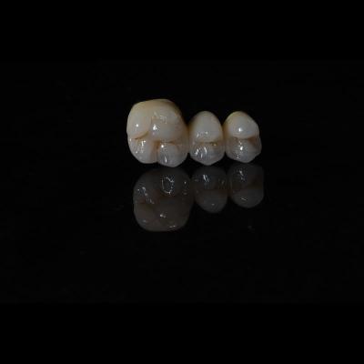 China Anti Wear Implant PFM Dental Bridge Prosthesis Teeth Replacement for sale