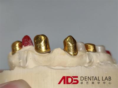 China Coroas dentárias telescópicas Prótese em odontologia personalizável à venda