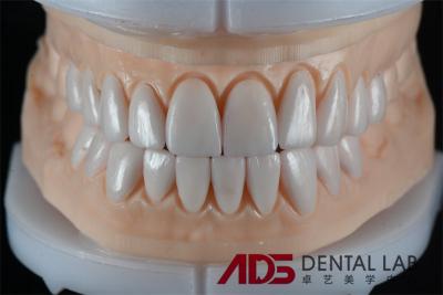 China China Dental Lab Laminado Dental E-Max Veneer Autoadhesivo en venta