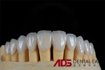 China Feldspathic Porcelain Laminate Dental Veneer Seamless Customized for sale