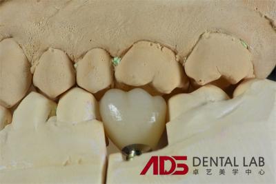 Chine Dentistique Les dents pleine bouche les implants de zirconium Abutment personnalisé CAD CAM à vendre