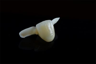 Cina Disponibile su misura Dental Resin-binded Maryland ponte da Shenzhen ADS laboratorio dentale in vendita